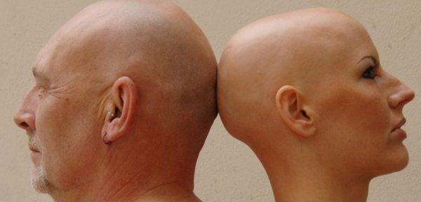 alopecia totale