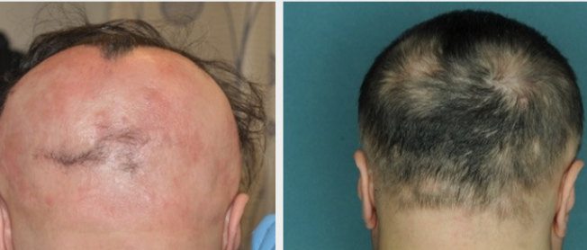 alopecia cicatriziale