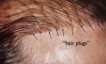 hair plugs
